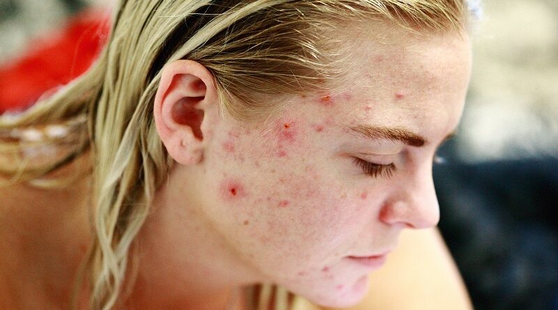 Tout ce que vous devez savoir sur l'utilisation des antibiotiques pour traiter l'acné