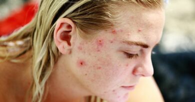 Acné du front : Causes possibles et remèdes maison contre l'acné