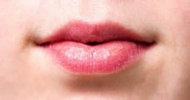 Chéilite angulaire : Symptômes et causes de cette maladie inflammatoire des lèvres